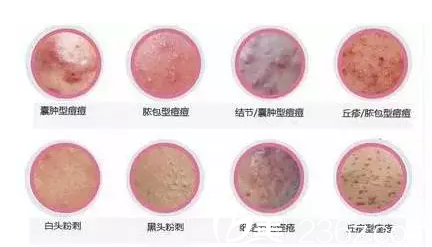 痘痘類型