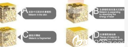 激光祛痘過程示意圖