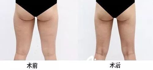 腿部抽脂效果怎么樣？看腿部抽脂案例