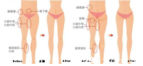 腿部抽脂示意圖