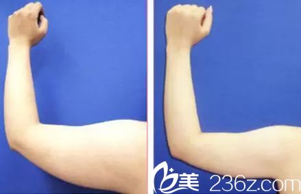 手臂吸脂真人案例對比圖