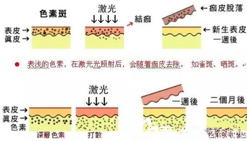 激光祛斑過(guò)程