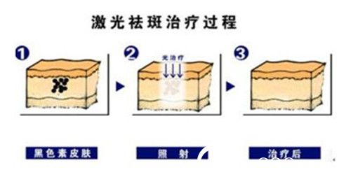 激光祛斑治療過(guò)程