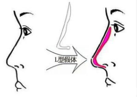 假體隆鼻示意圖