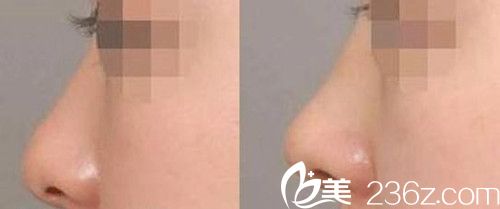 玻尿酸隆鼻效果