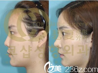 李珉奭院長鼻整形真人前后效果對(duì)比