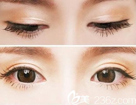 杭州割個雙眼皮要多少錢