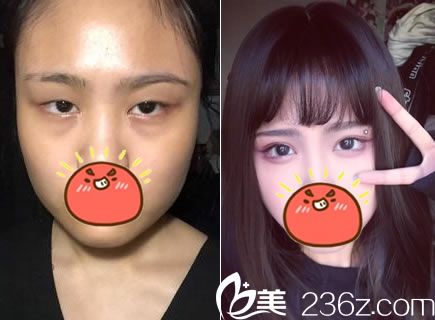 杭州美萊整形醫(yī)院韓超雙眼皮