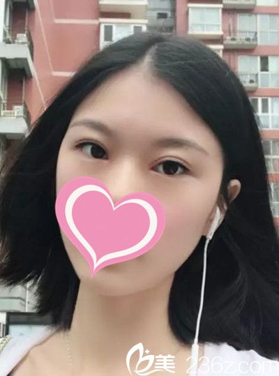 大家?guī)臀铱纯匆粋€月前我在贛州儷人整形做的雙眼皮手術怎么樣？