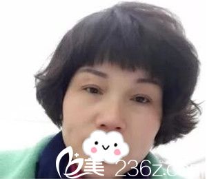 上眼皮松馳的我去郴州唯美咨詢并直接做了切開雙眼皮后老公說我年輕10歲！