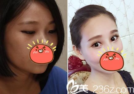 杭州時光整形醫(yī)院張常做雙眼皮