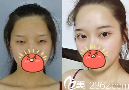 <!--<i data=20240703-sp></i>-->整形張宇翔割雙眼皮