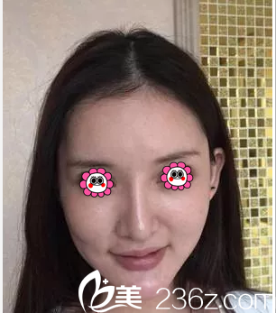 在北京米蘭柏羽麗都做埋線提升前樣子 在北京米蘭柏羽麗都做埋線提升前樣子