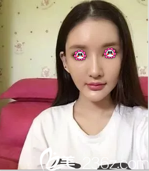 在北京米蘭柏羽麗都做埋線提升第27天樣子 在北京米蘭柏羽麗都做埋線提升第27天樣子