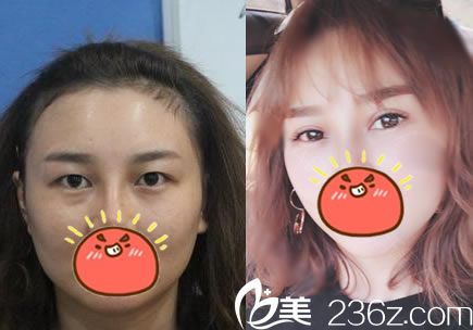 <!--<i data=20240703-sp></i>-->張院長雙眼皮