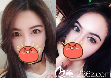 杭州連天美姜鑫利割雙眼皮