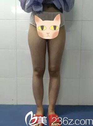 大腿吸脂手術(shù)前 大腿吸脂手術(shù)前