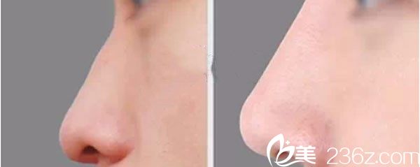 魏邦敏主任隆鼻效果代表案例 魏邦敏主任隆鼻效果代表案例