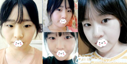 淮北割雙眼皮哪家好？淮北時光案例對比