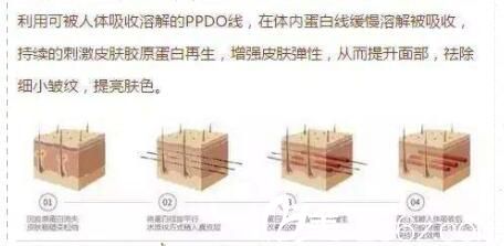 什么是面部線雕 什么是面部線雕