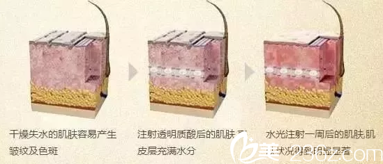 水光注射美膚 水光注射美膚