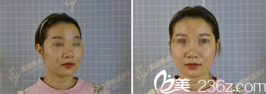 在桂林美麗焦點(diǎn)做激光美膚前 在桂林美麗焦點(diǎn)做激光美膚前