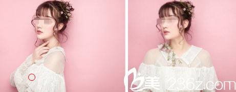 預(yù)約桂林美麗焦點(diǎn)楊天然給我做了激光美膚之后 告別了痘痘痘印和色斑