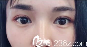 寫一篇我去韓國清潭讓成鎮(zhèn)模做眼睛的日記，感謝成院長讓我擺脫了雙眼皮失敗