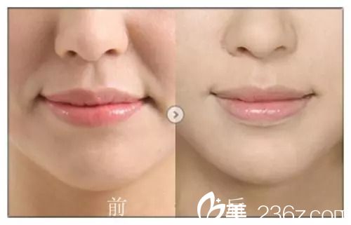 瘦臉除皺除皺效果怎么樣 瘦臉除皺除皺效果怎么樣