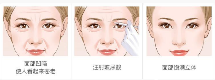 注射玻尿酸除皺原理