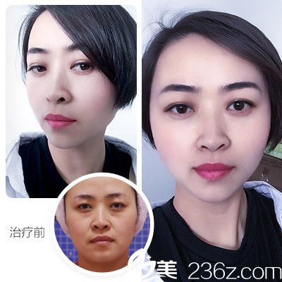 玻尿酸除皺案例對(duì)比圖