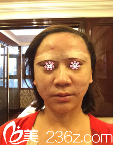 手術(shù)當(dāng)天 手術(shù)當(dāng)天