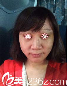 第二天效果 第二天效果