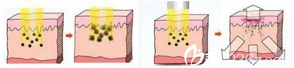 皮秒激光祛斑原理