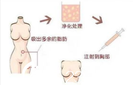 自體脂肪豐胸過(guò)程示意圖