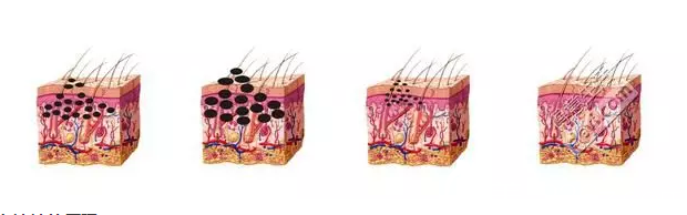 白瓷娃娃清除黑色素過(guò)程示意圖