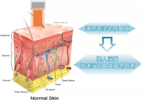 白瓷娃娃美膚示意圖