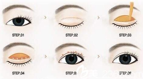 割雙眼皮手術(shù)