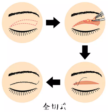 割雙眼皮原理