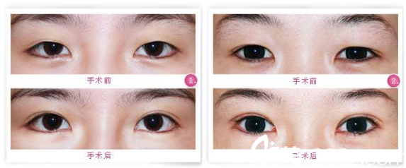 腫眼泡做雙眼皮案例前后對比