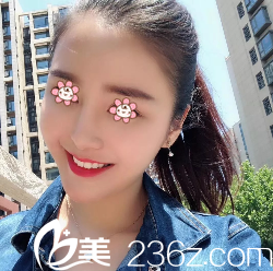 何林面部線雕提升術(shù)后10天 何林面部線雕提升術(shù)后10天