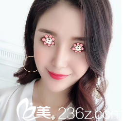 寧夏華美整形美容醫(yī)院何林這個面部線雕提升做得讓我有了個美美的蘋果??！