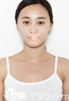 韓國(guó)博朗溫整形外科術(shù)前照 韓國(guó)博朗溫整形外科術(shù)前照