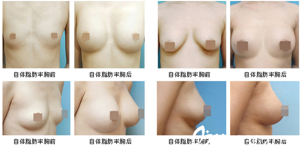 自體脂肪隆胸前后照片