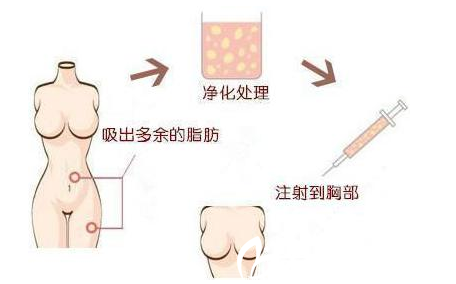 自體脂肪隆胸的過(guò)程