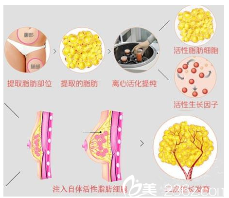 自體脂肪隆胸的原理