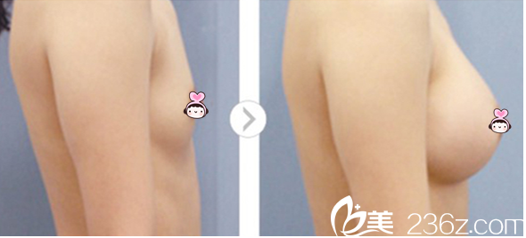 自體脂肪隆胸前后對(duì)比