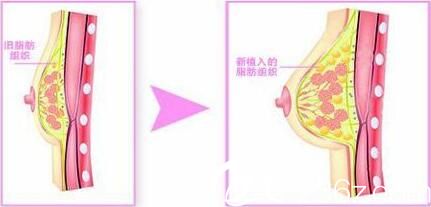 自體脂肪隆胸填充的位置