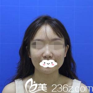 隆鼻失敗的我 隆鼻失敗的我