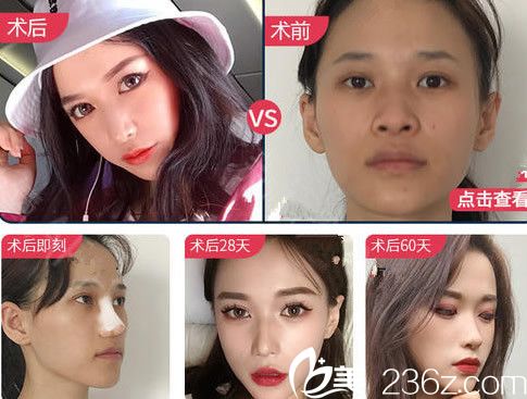 穆威鼻綜合案例及其恢復(fù)過(guò)程圖展示 穆威鼻綜合案例及其恢復(fù)過(guò)程圖展示